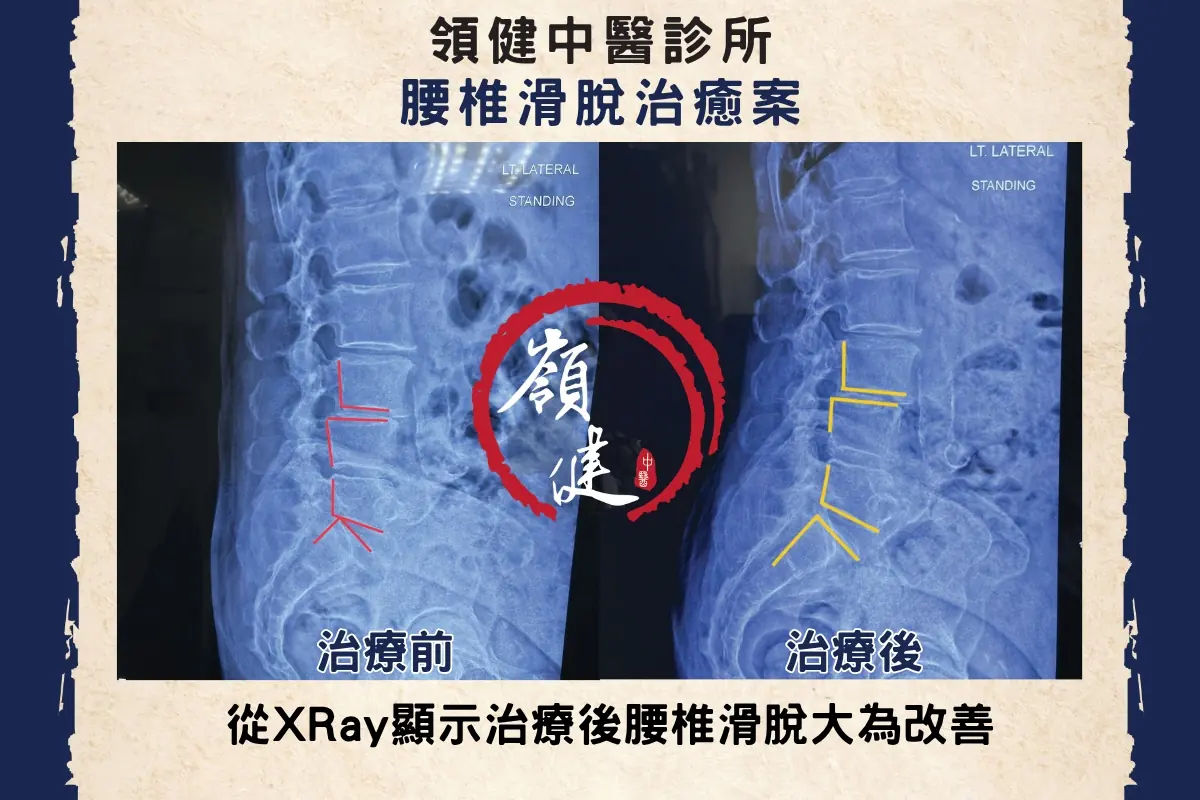 腰椎滑脫治癒案